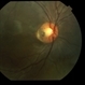 Optic Nerve Pit Optic Nerve Pit